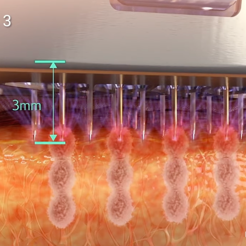 Morpheus8 treatment in Philadelphia combines radiofrequency with microneedling for firmer, more youthful skin.