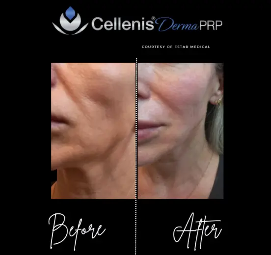 Philadelphia body contouring clinic before and after results. Schedule an appointment today with the Philly Wellness Center.