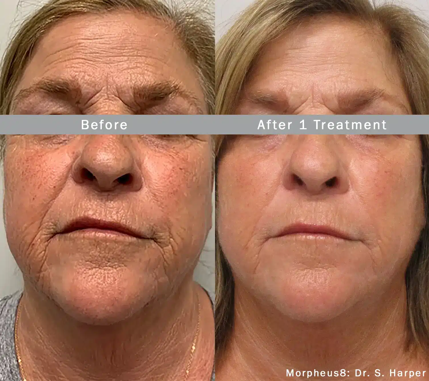 Morpheus8 Treatment Before & After