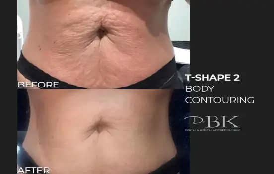 Philadelphia T-Shape 2 body sculpting treatment before and after results.
