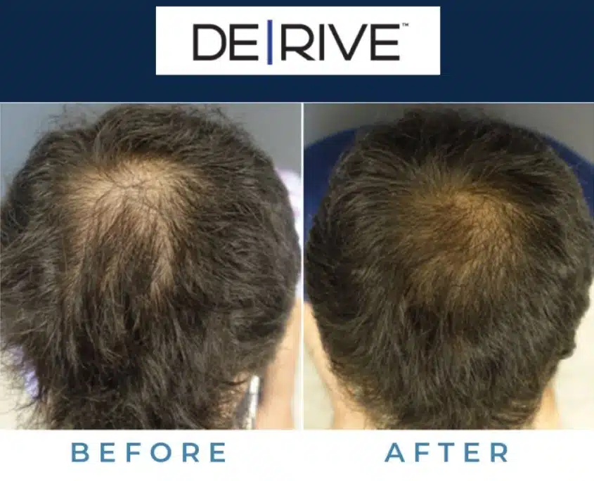 Before and after hair restoration in Philadelphia with De|Rive hair loss treatment.