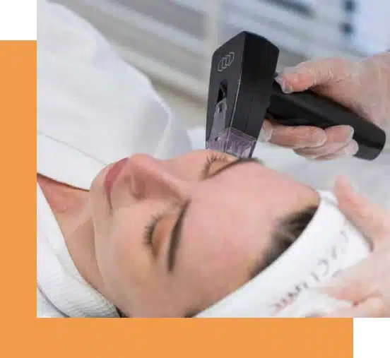 Facial contouring treatment with Morpheus8 in Philadelphia. RF microneedling skin treatment at Philly Wellness Center.