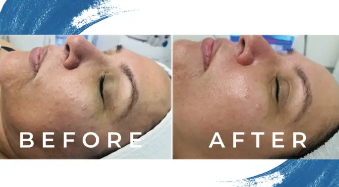 Results of laser skin treatment, Nouvaderm in Philadelphia show smooth skin with improvements to pigmentation.