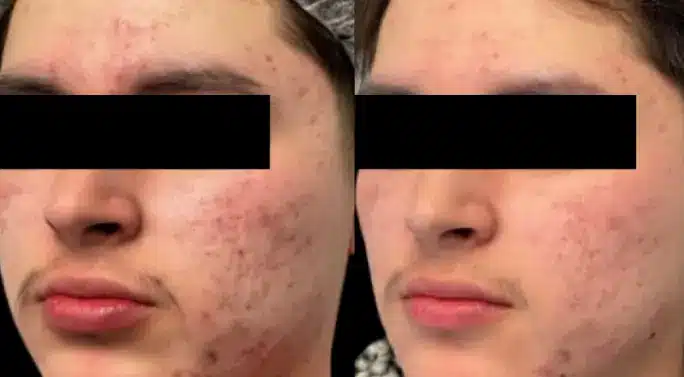 Comparison of facial acne scars prior to and after Nouvaderm laser resurfacing skin treatment, Philly Wellness Center.