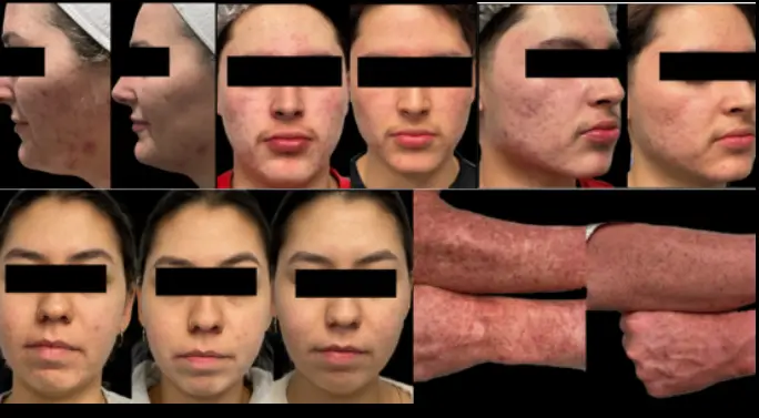 Before and after laser skin resurfacing results for Philly Wellness Center who got treatment with Nouvaderm.