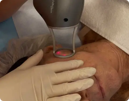 Patient at the Philly Wellness Center getting treatment with NOUVADerm in Philadelphia, PA. Laser skin resurfacing for smoother, firmer skin.
