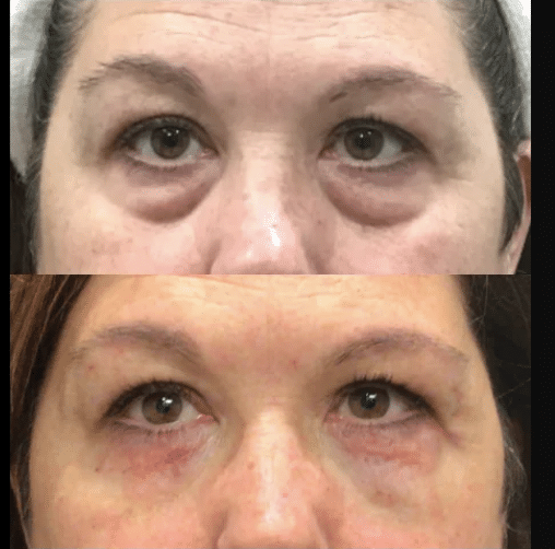 Before and after Cellenis Derma PRP filler treatment in Philadelphia. Skin treatment to tighten skin, reduce fine lines and wrinkles, and improve skin texture.