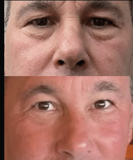 Lip filler treatment in Philadelphia with Cellenis DermaFiller. Results show fuller lips and cheeks. Injectable dermal fillers in Philadelphia.