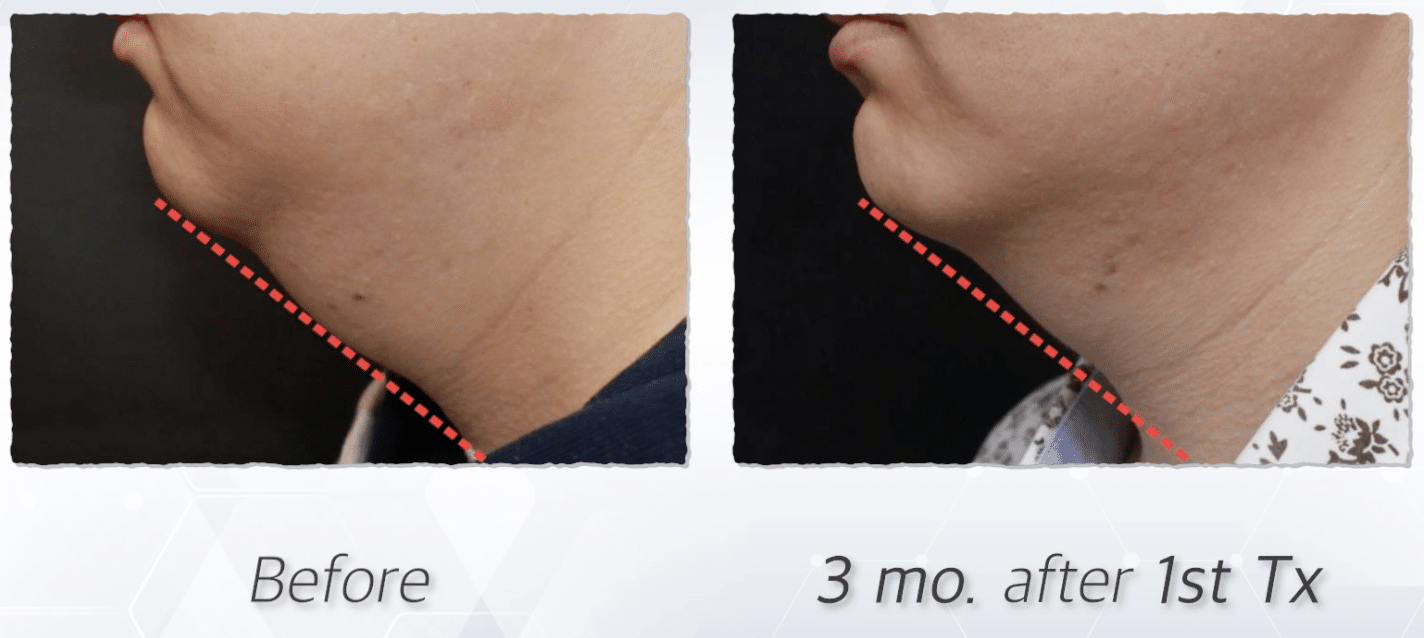 Results of Philadelphia PRP dermal filler treatment at Philly Wellness Center. Fill in eye hollows and reduced sagging.