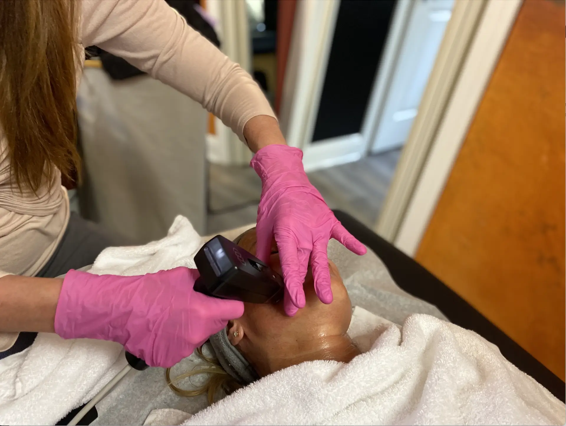 Morpheus8 RF microneedling treatment improving skin texture, acne scars, stretch marks and large pores